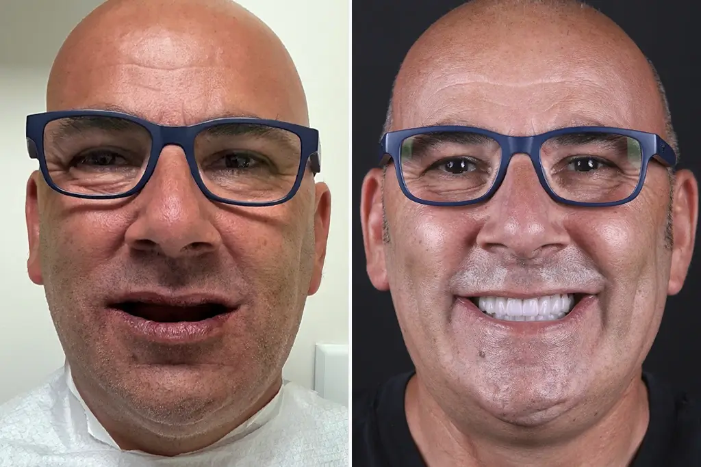 Full-Mouth-Dental-Implants