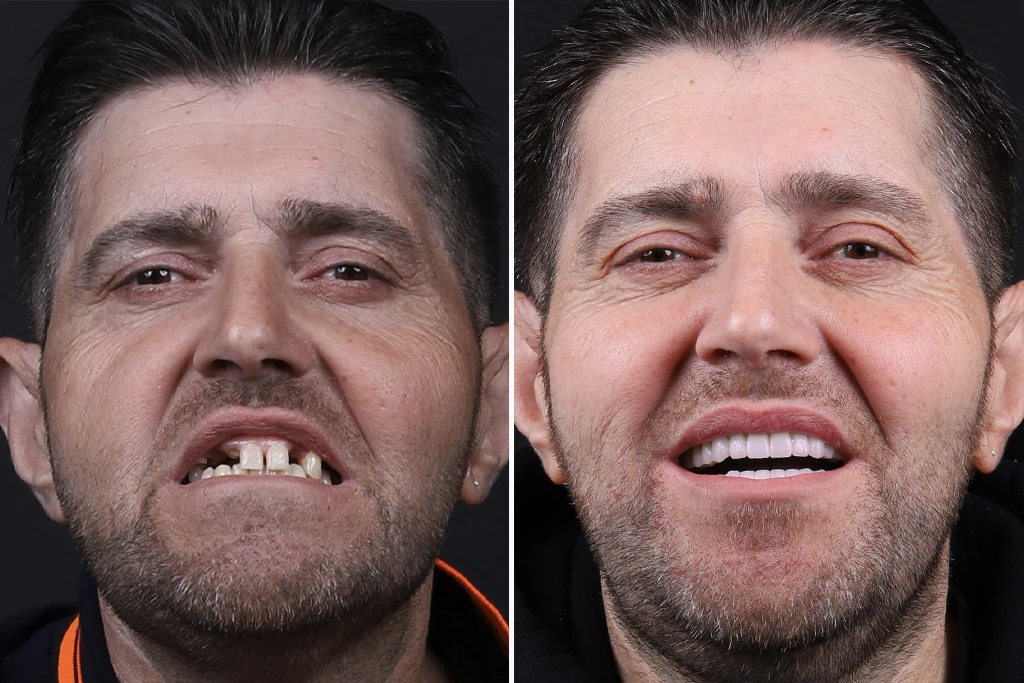 Dental-Implants