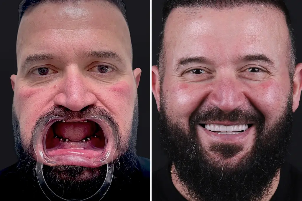 Full-Mouth-Dental-Implants