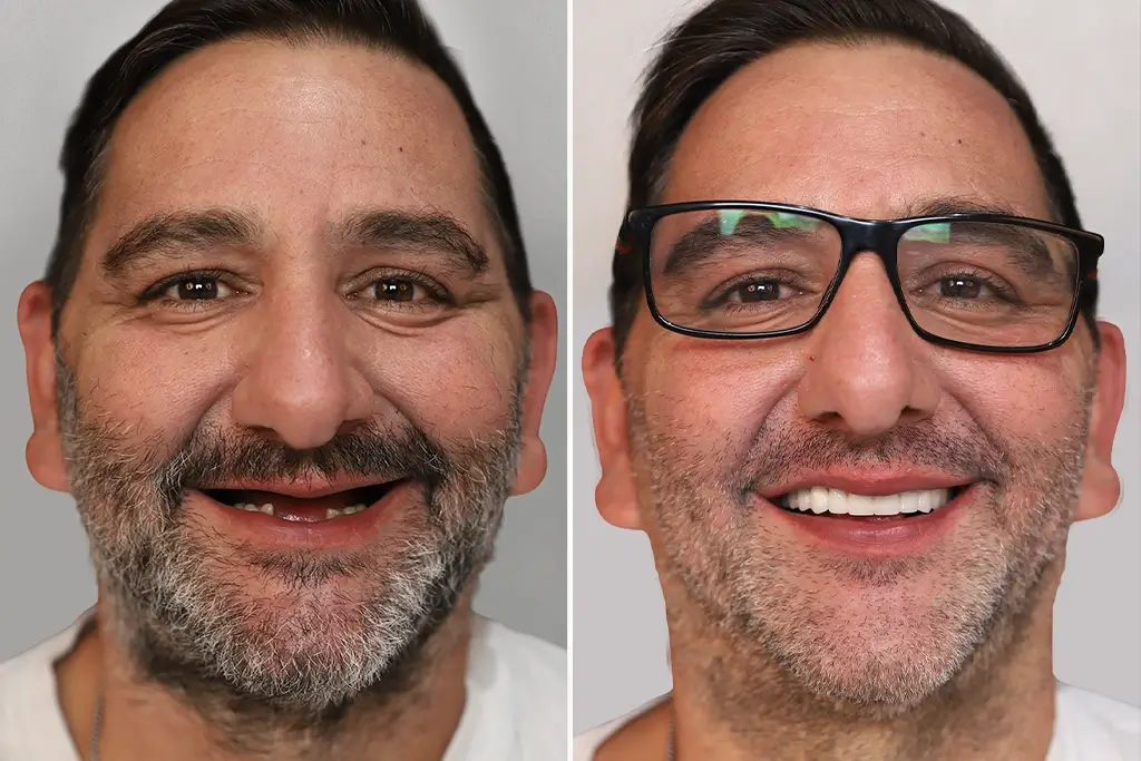 Full-Mouth-Dental-Implants