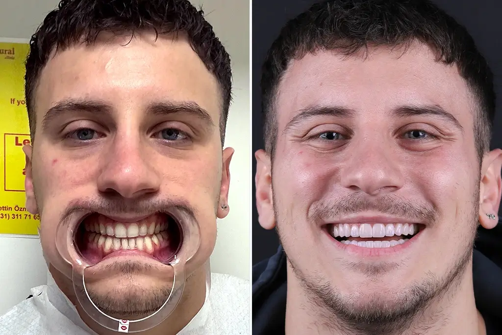 Dental-Veneers