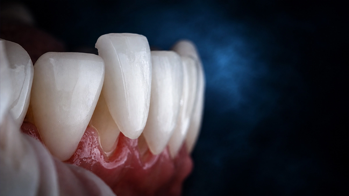 Dental-Veneers