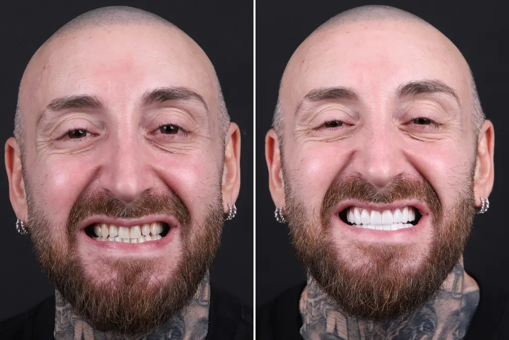Dental-Veneers