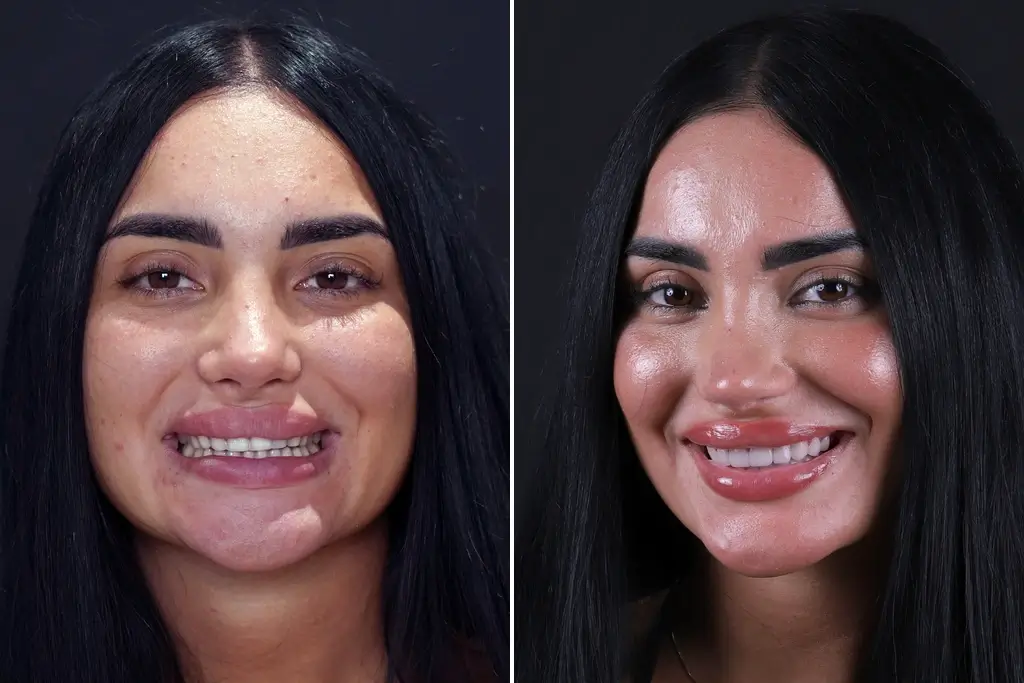 Dental-Veneers