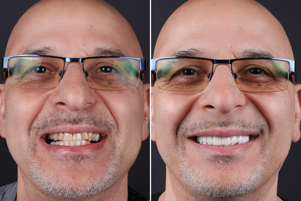 Before treatment