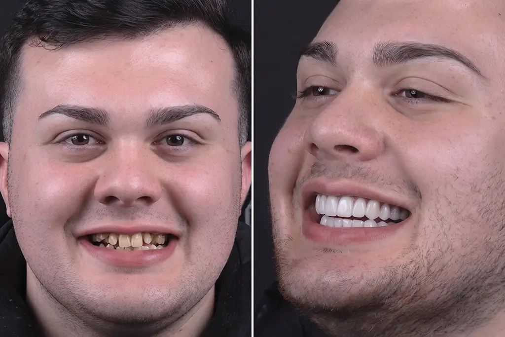 Smile-Makeover