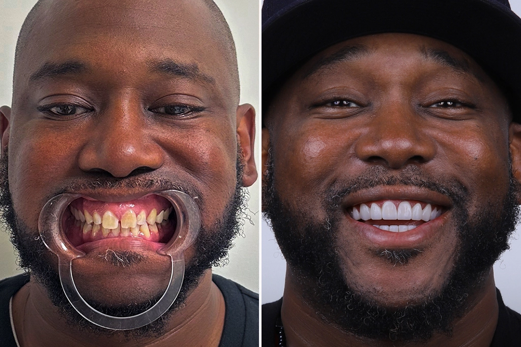 Dental-Crowns