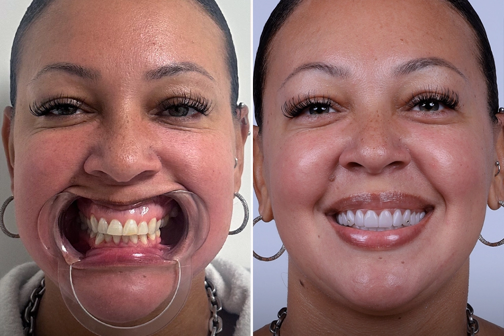Dental-Crowns