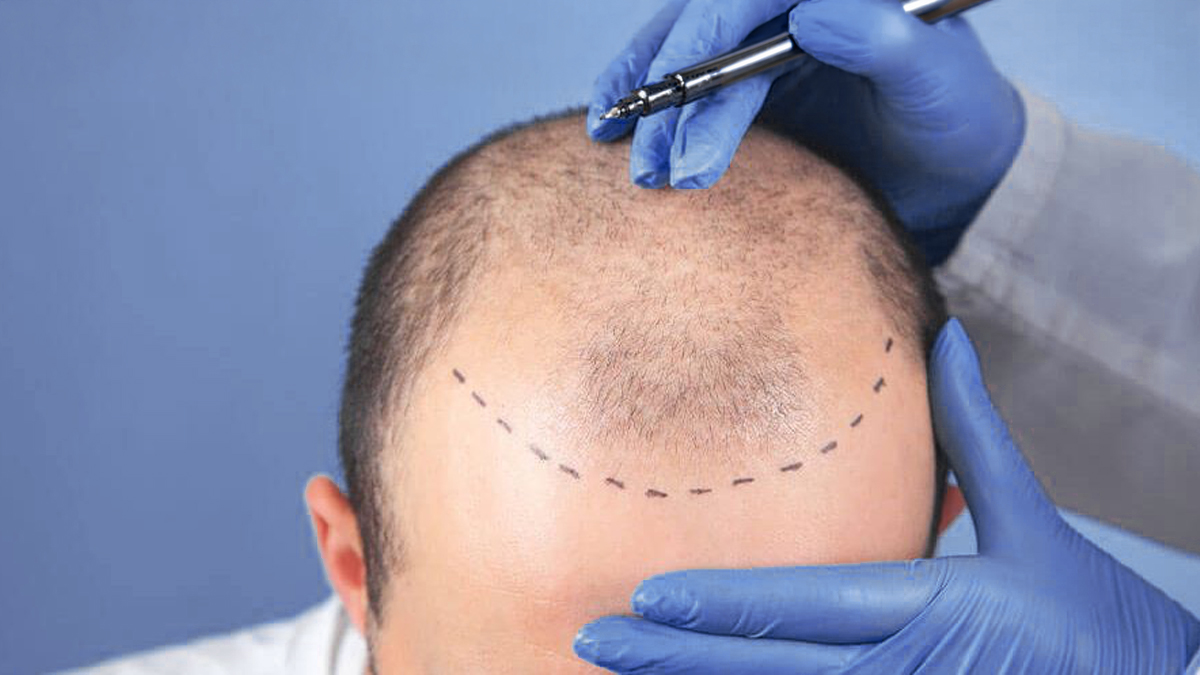 FUE Hair Transplant