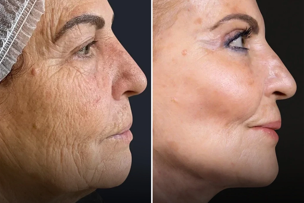 Facelift2