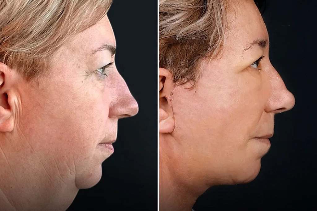 Facelift3
