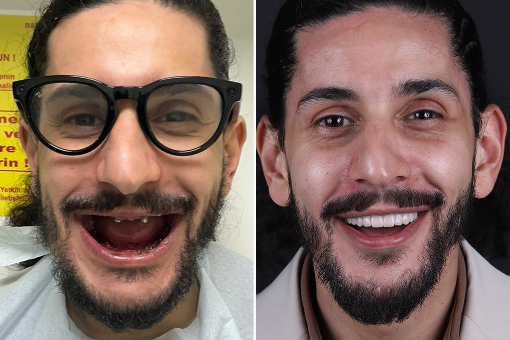 Full-Mouth-Dental-Implants