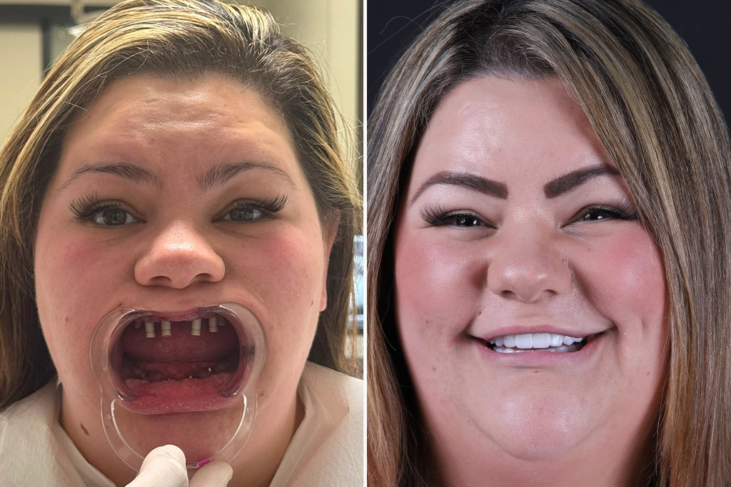 Full-Mouth-Restoration