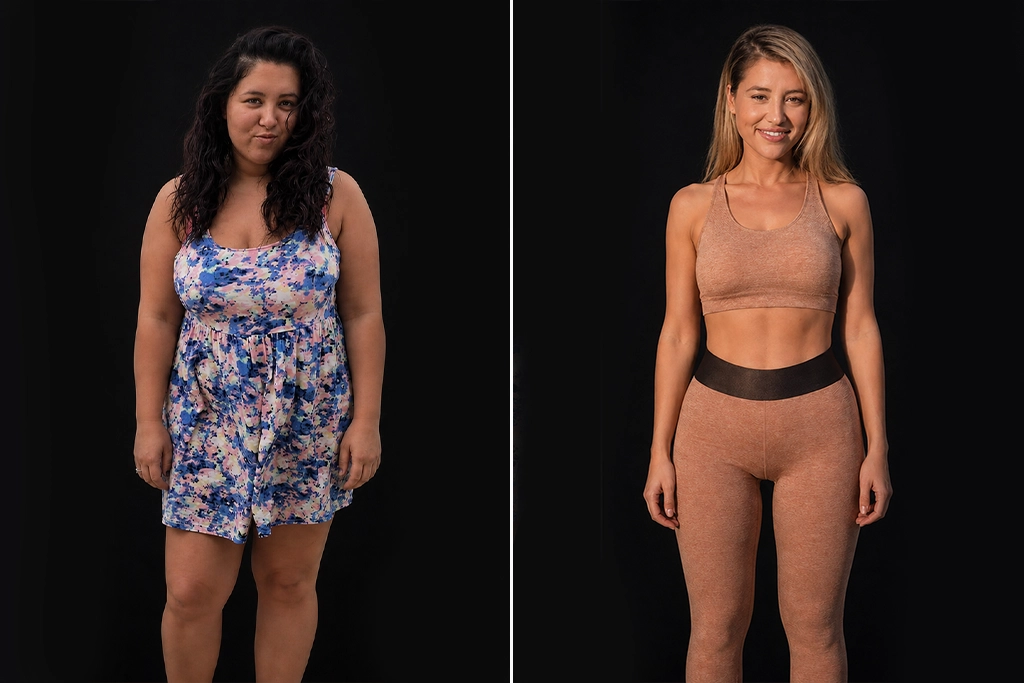 Gastric Bypass before after (1)