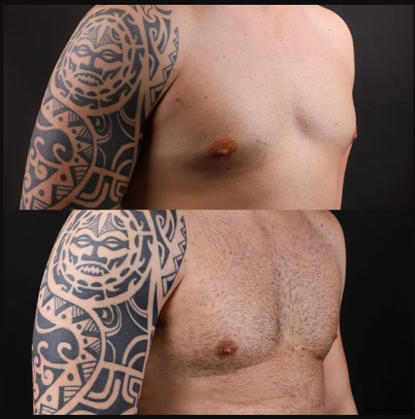 Gynecomastia-before-after.png