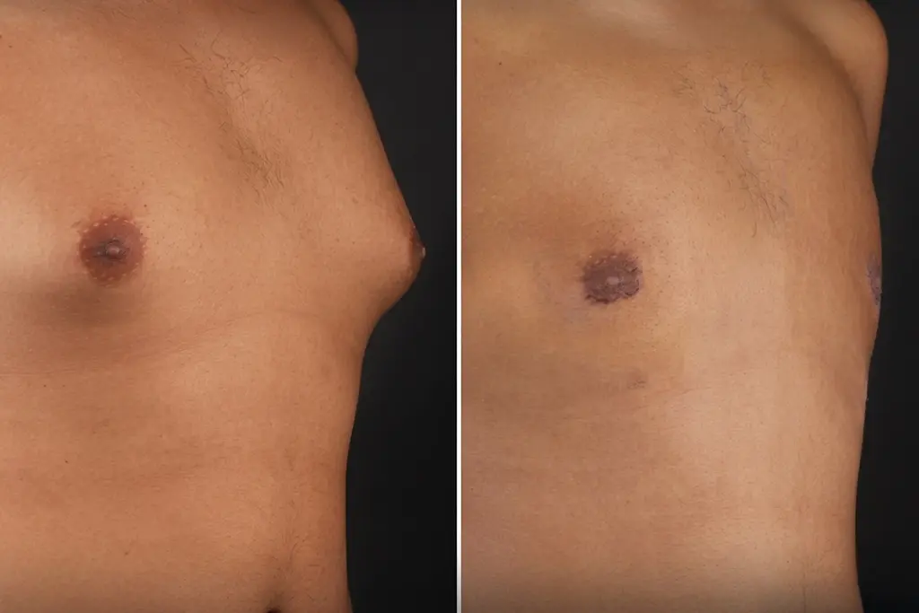 Gynecomastia1