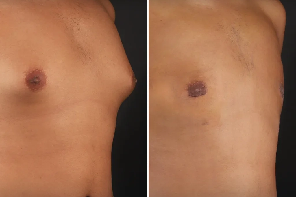 Gynecomastia1