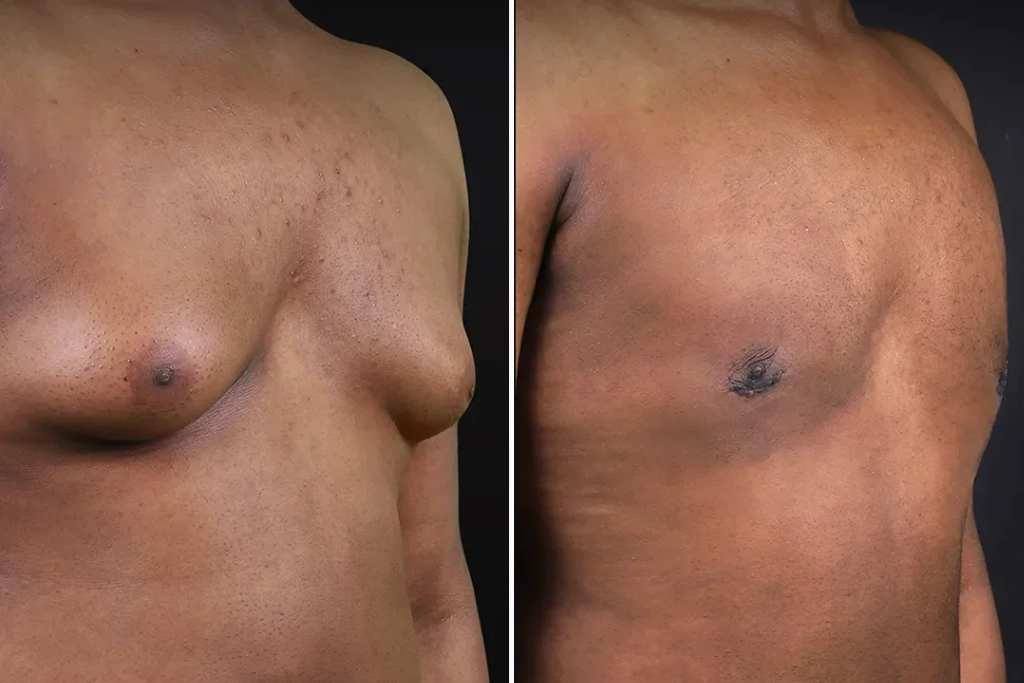 Gynecomastia2