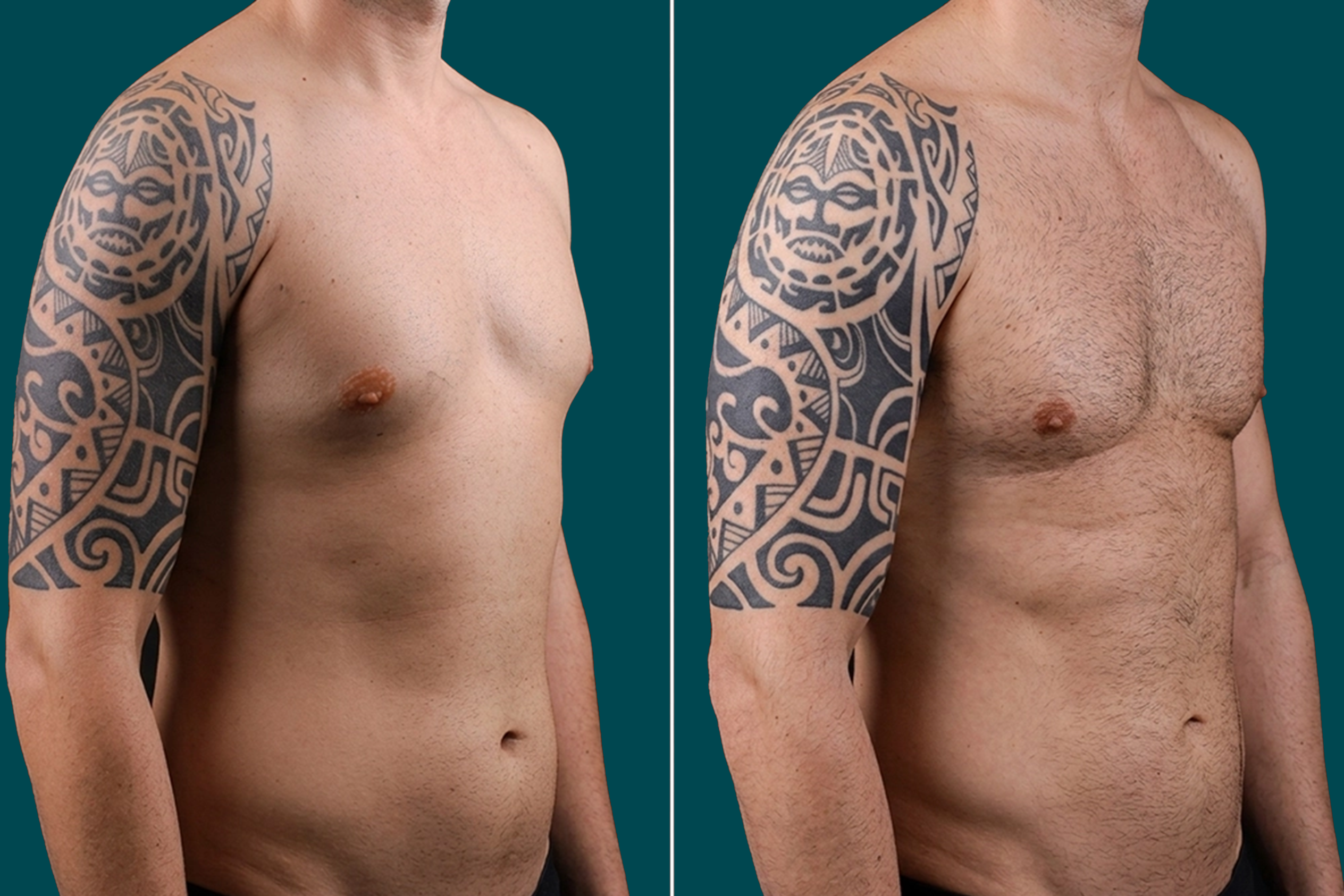 Gynecomastia Surgery Before and After 3