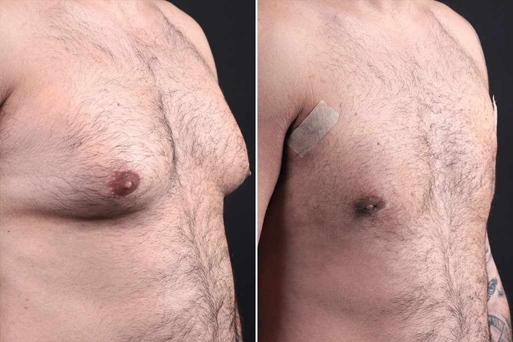Gynecomastia5
