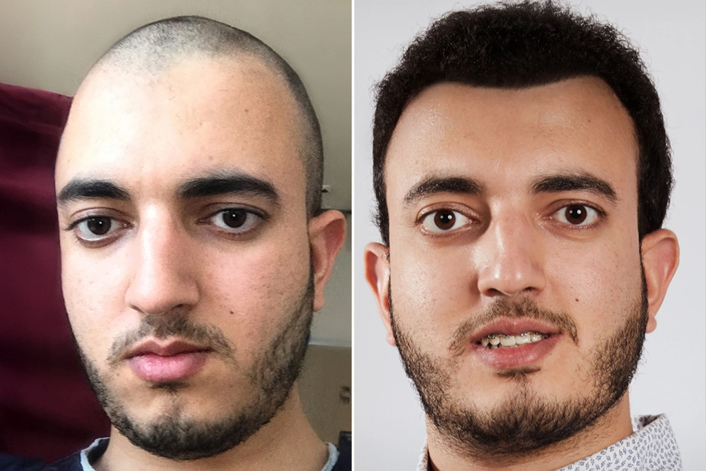 Before treatment