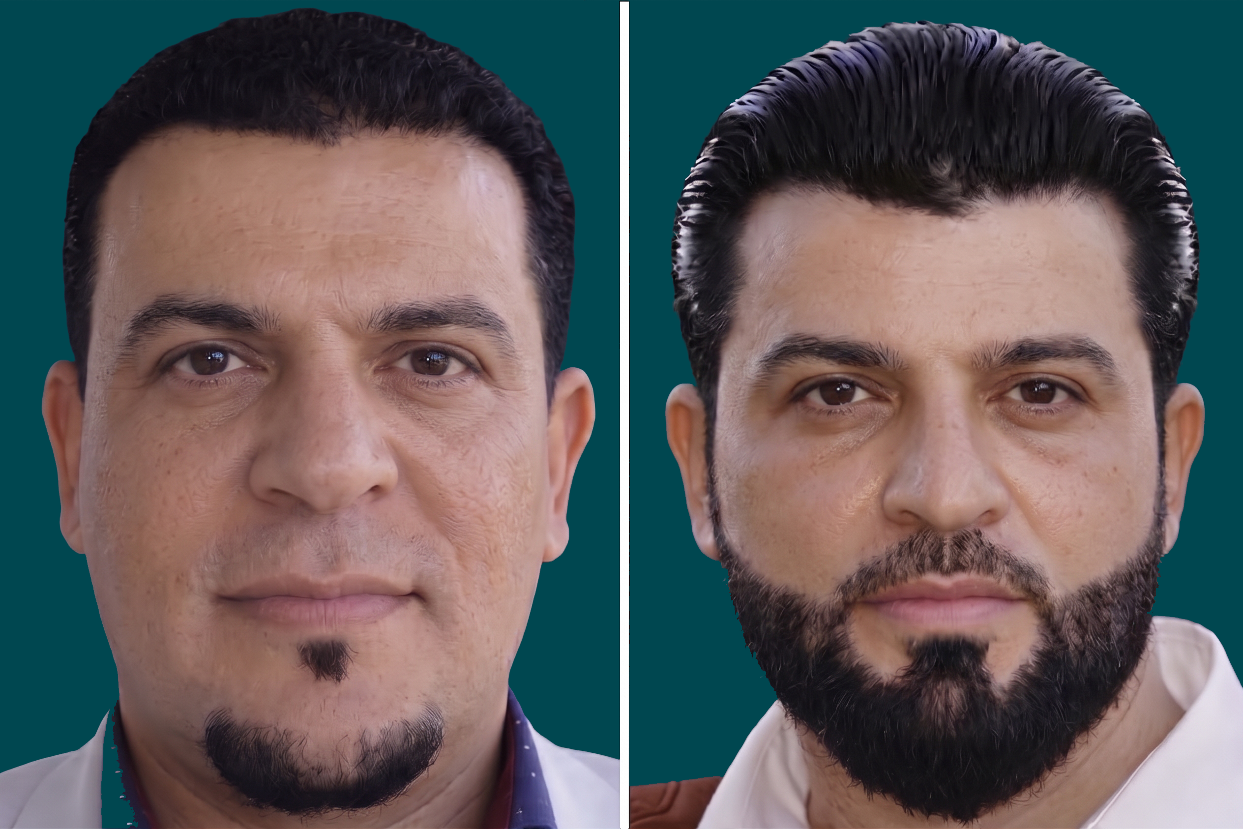 Hair-Transplant-DHI Hair Transplant 5