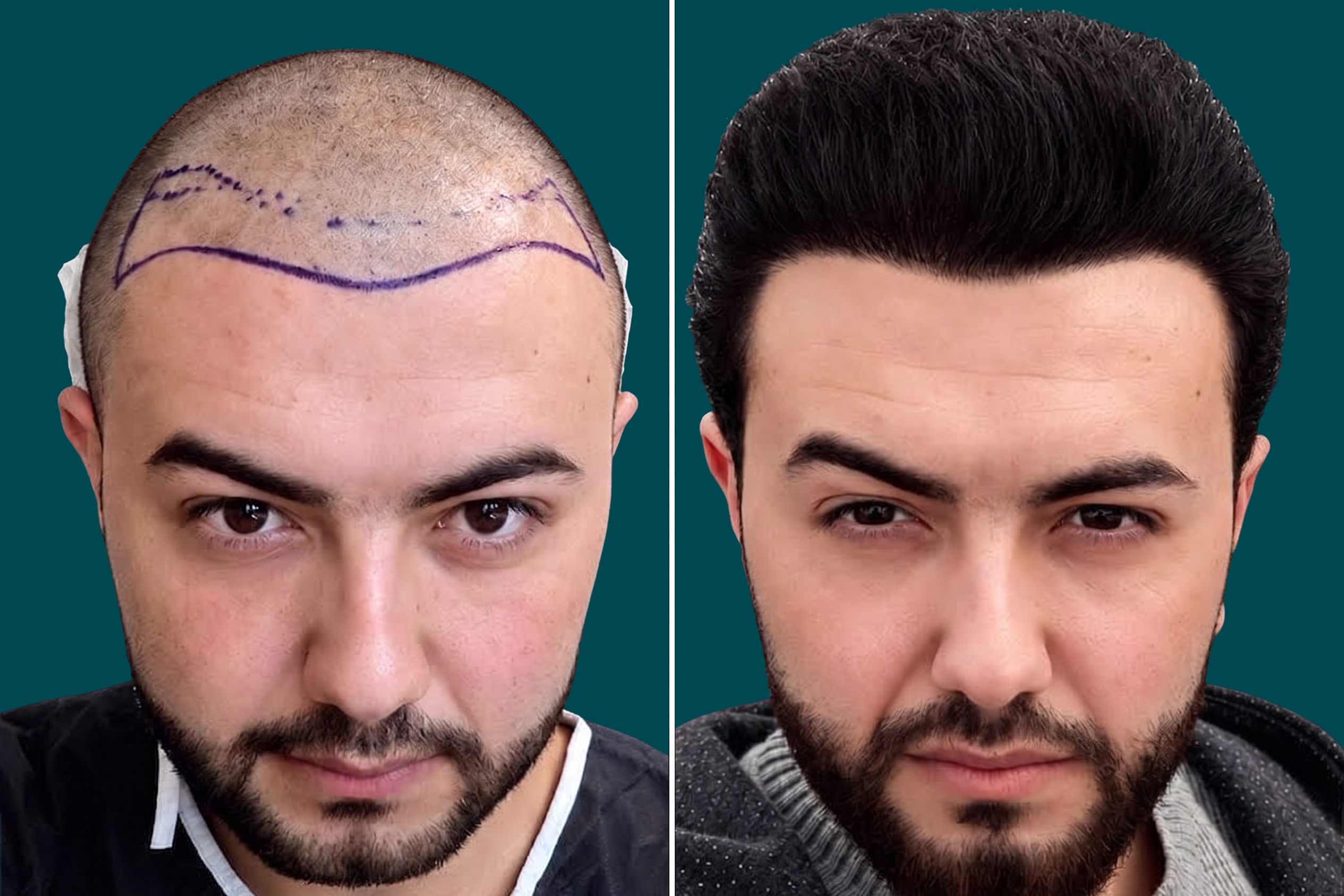 Hair-Transplant-FUT Hair Transplant 3