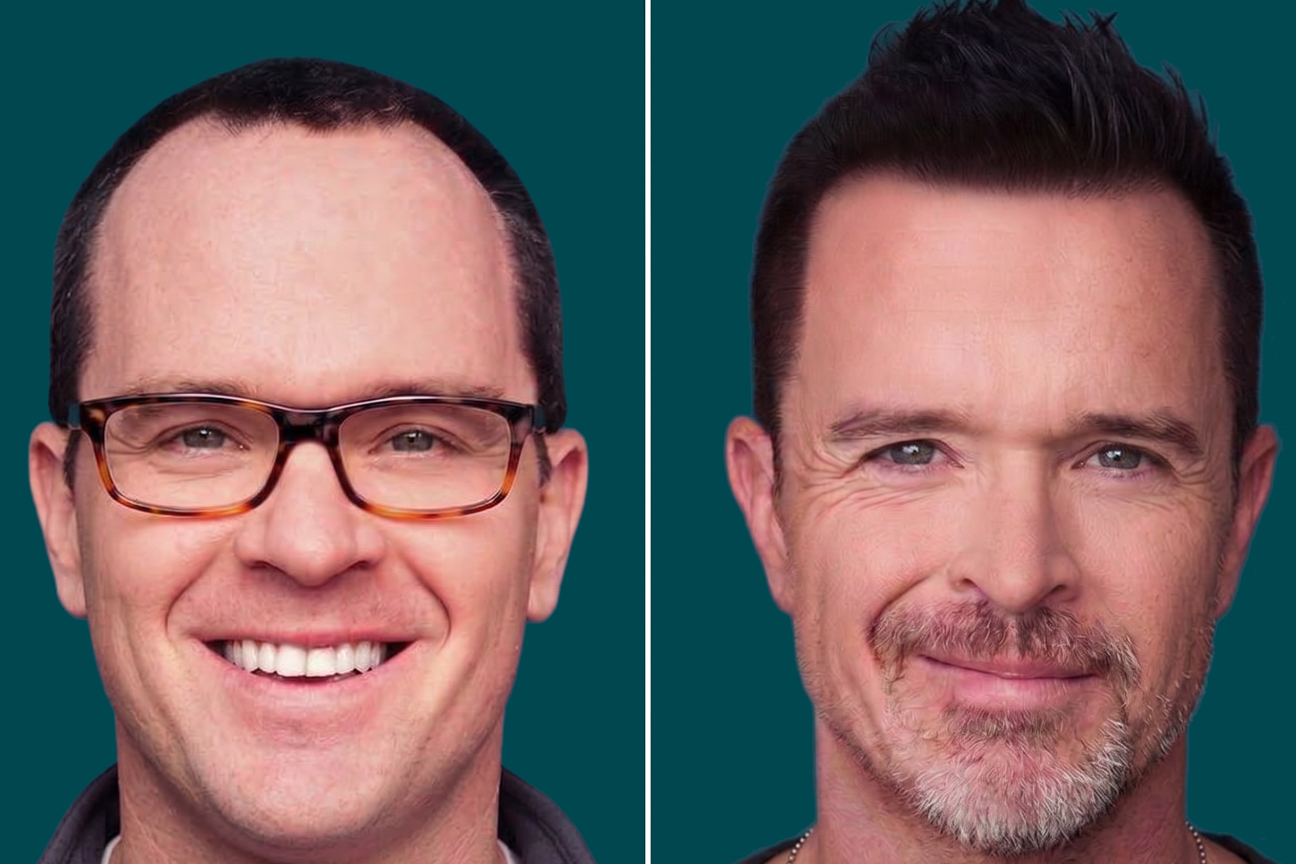Hair-Treatments-Hair Transplant 12