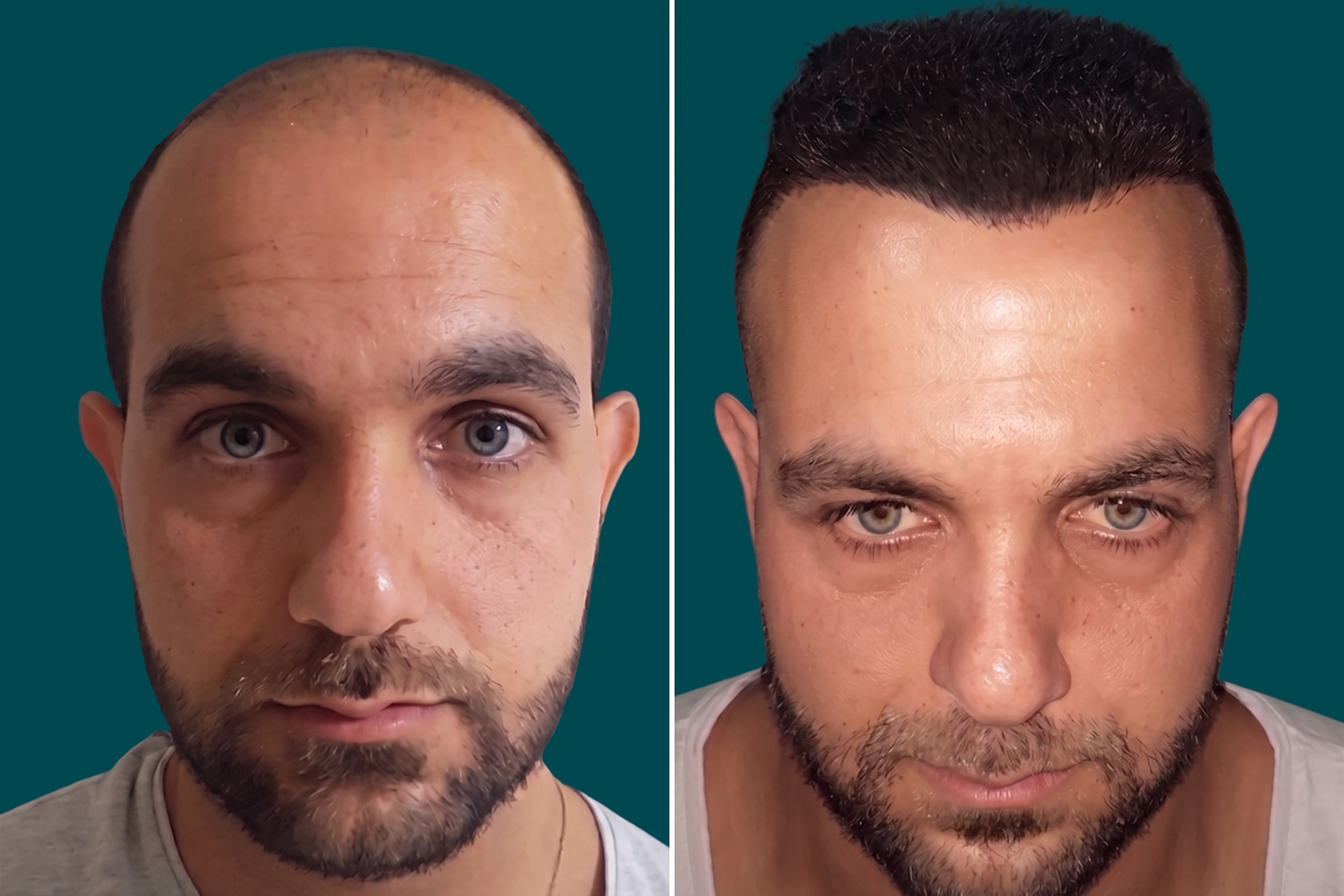 Hair-Transplant-Hybrid Hair Transplant 3