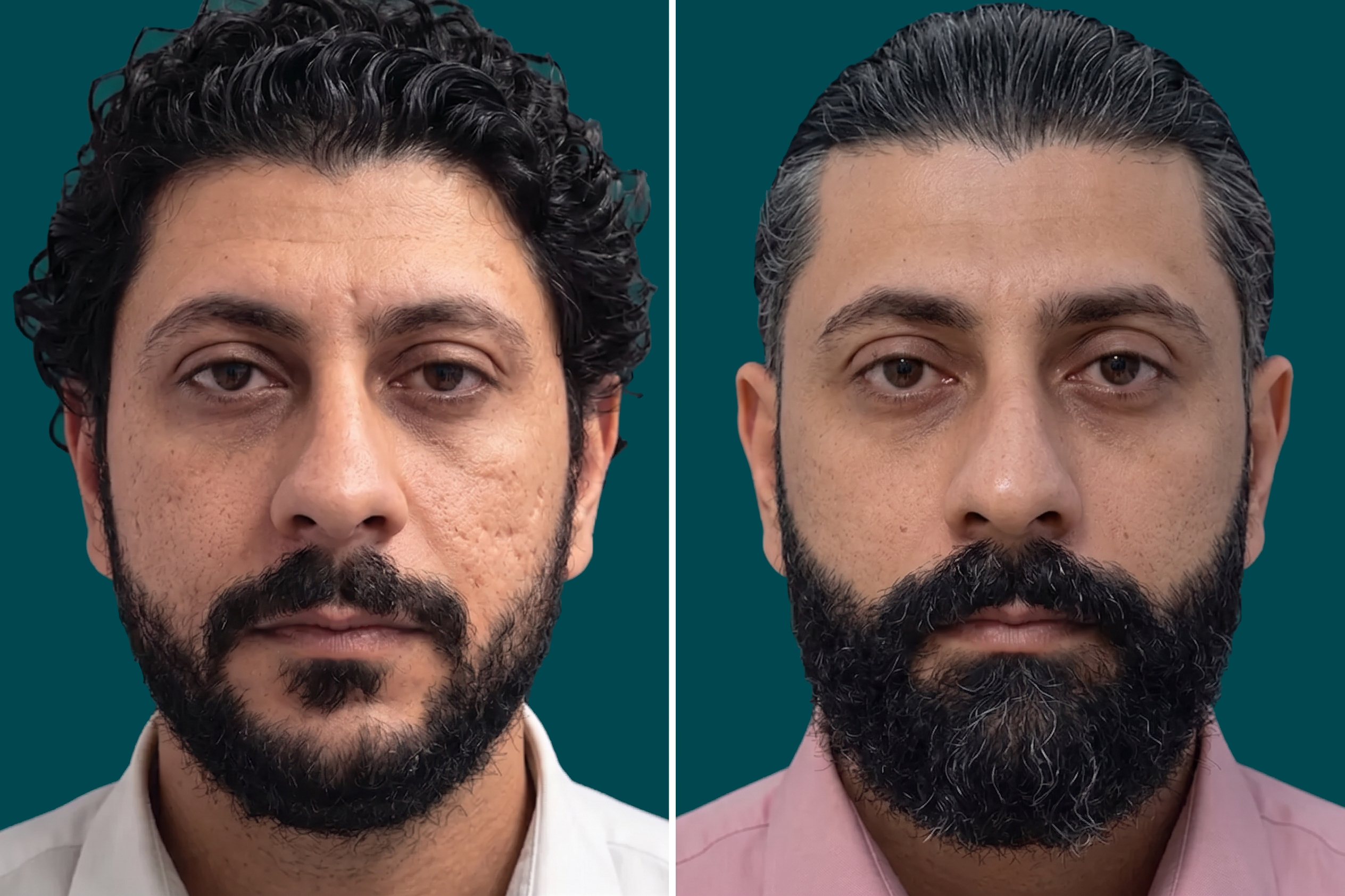 Hair-Treatments-Hair Transplant 10