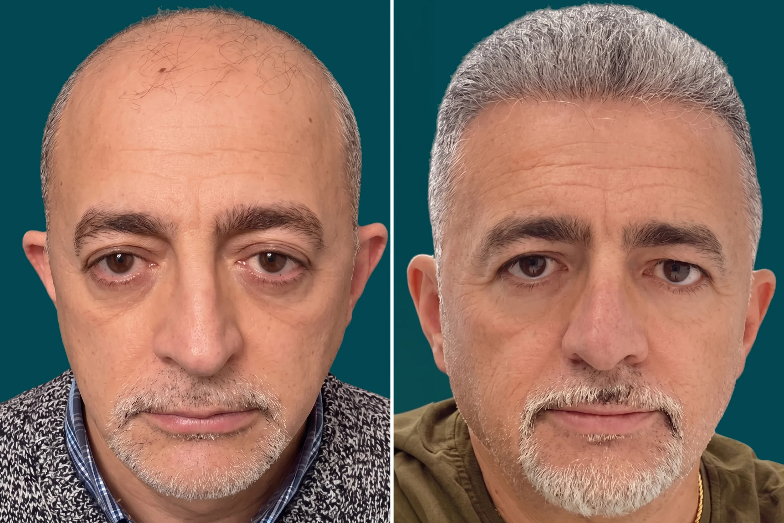 Hair-Treatments-Hair Transplant 11
