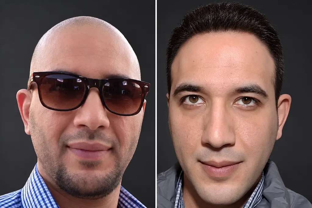 Hair Transplant Before After 5