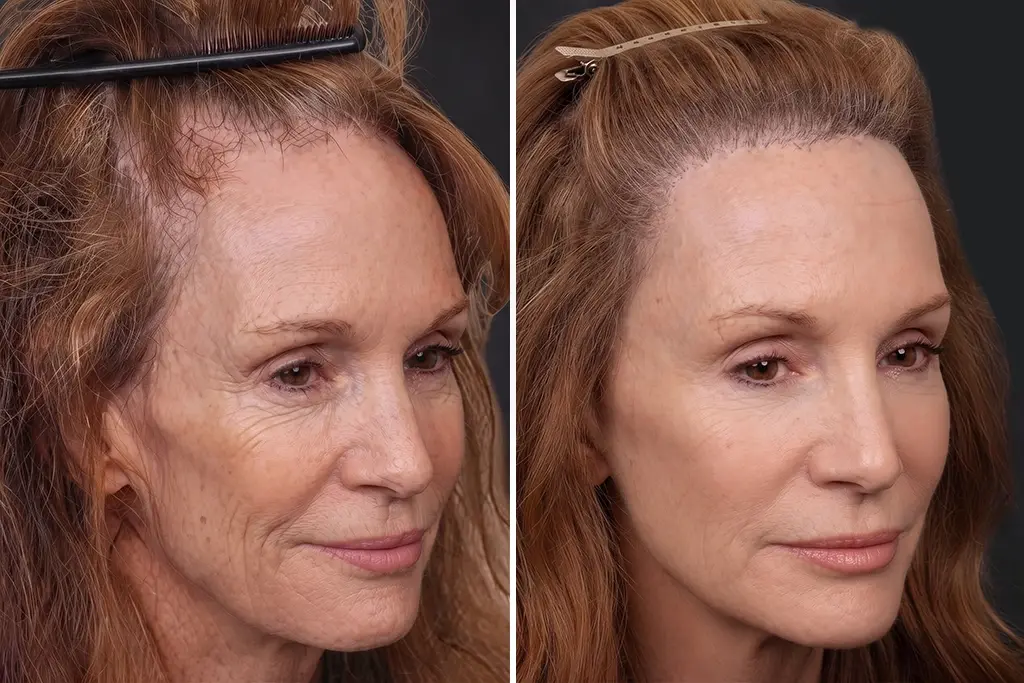 Before treatment