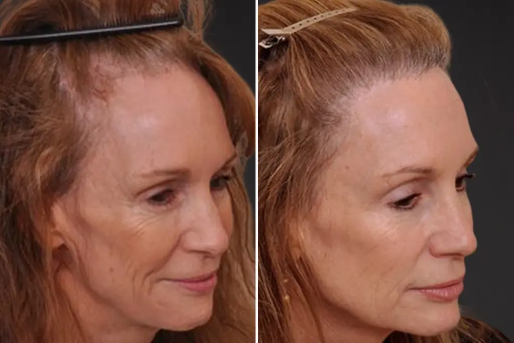 Female Hair Transplant Before After 2