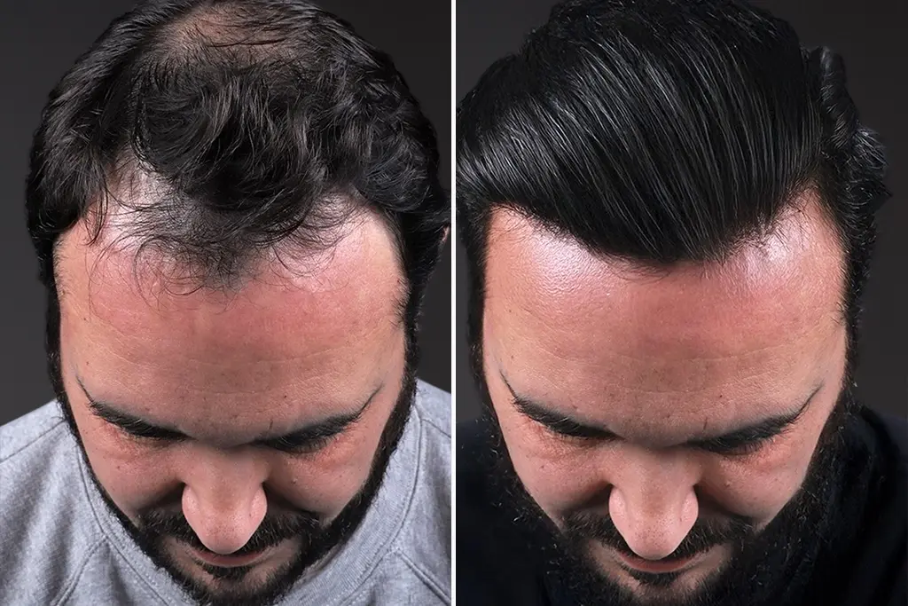 Hair Transplant Before After 2