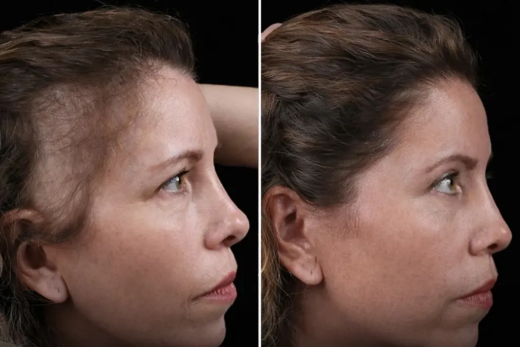 Female Hair Transplant Before After 2