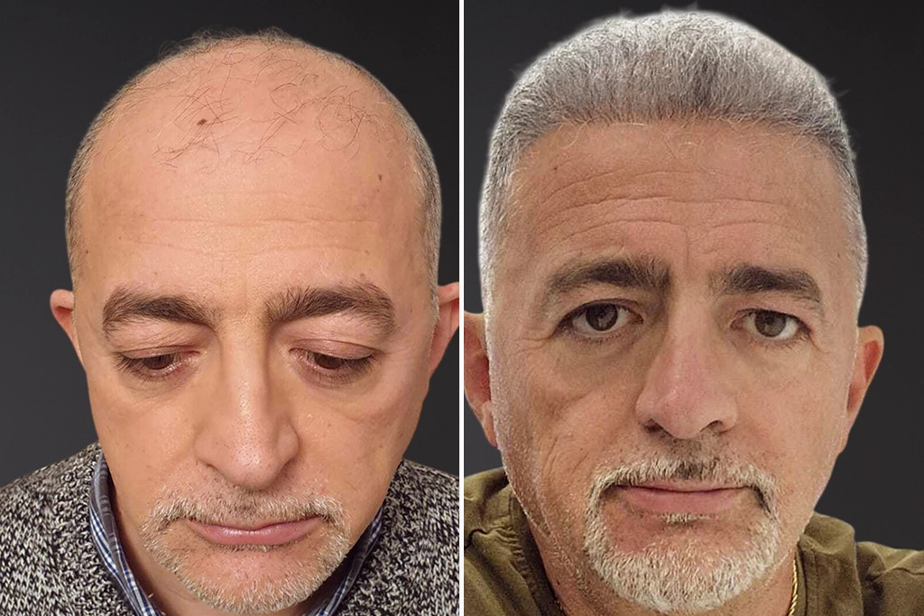 Hair Transplant Before After 5