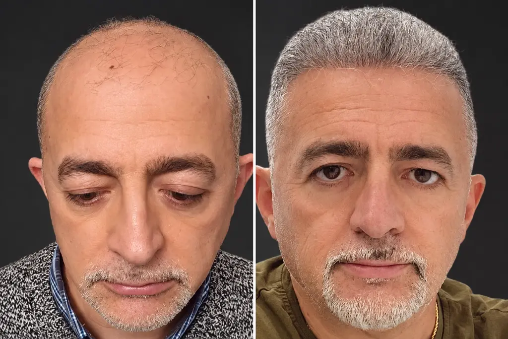 Hair Transplant Before After 4