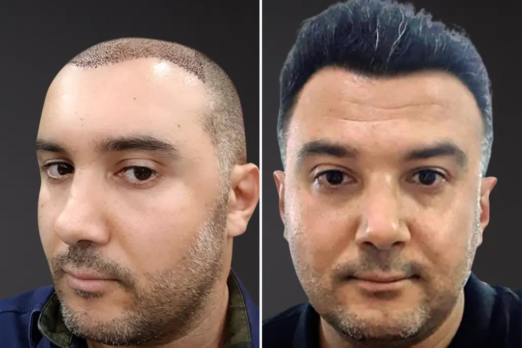 Hair Transplant Before After 4