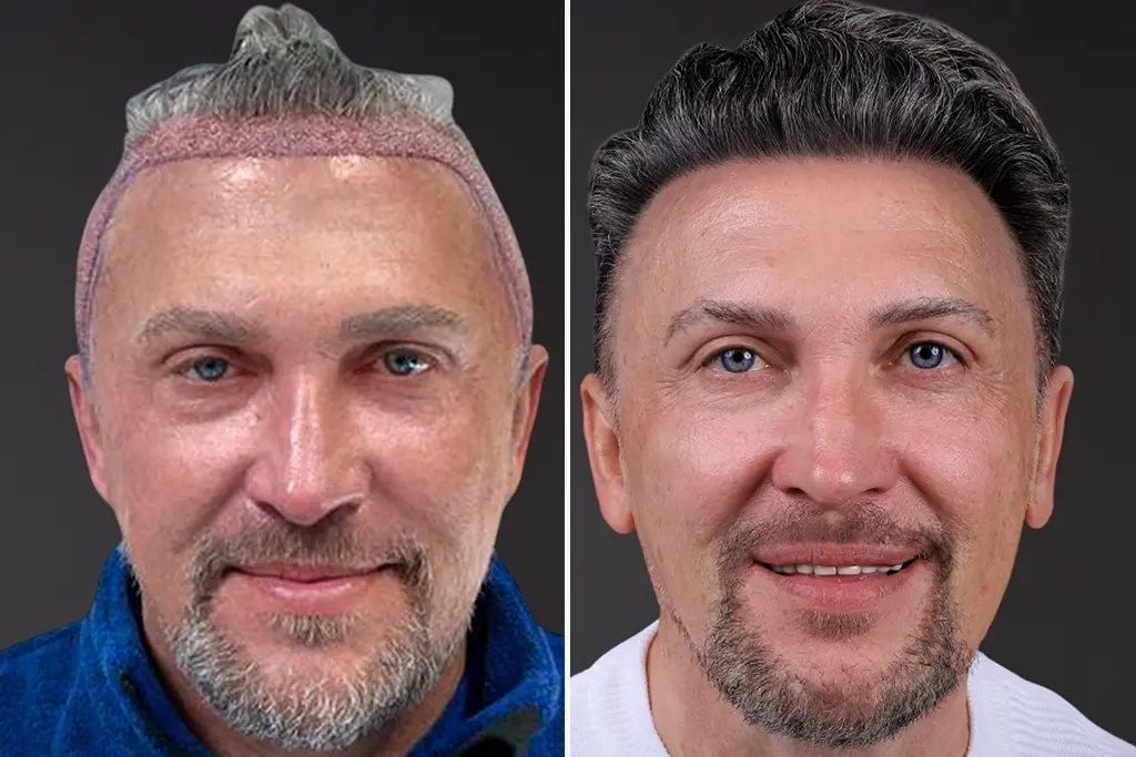 Hair Transplant Before After 1