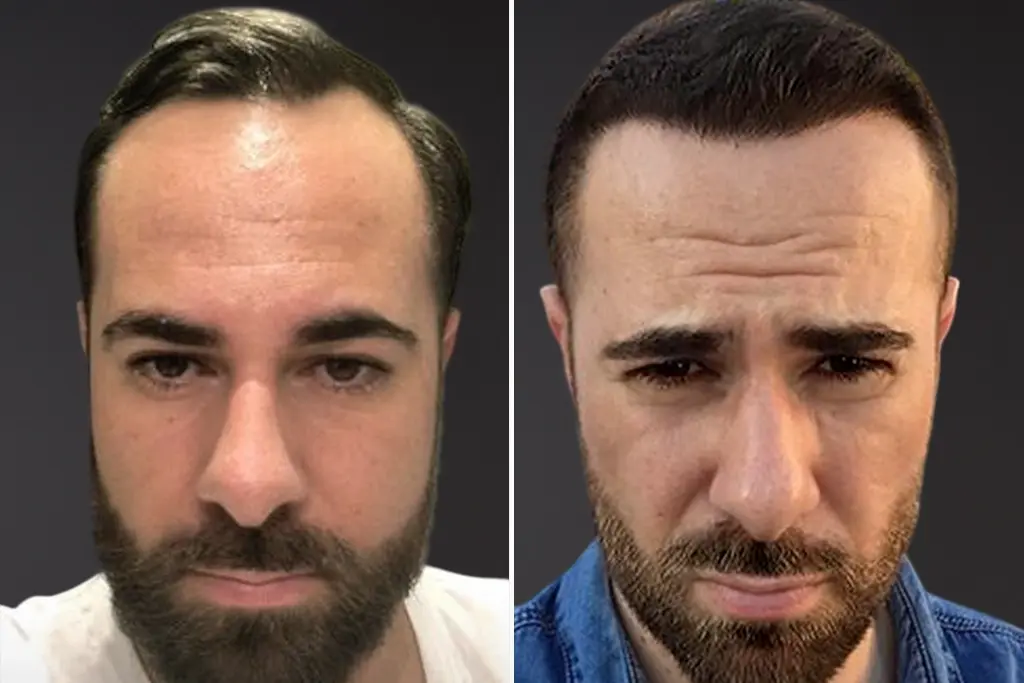 Unshaven Hair Transplant