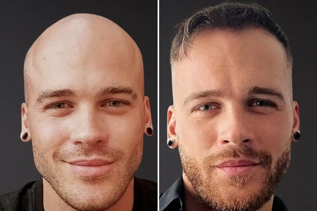 FUT Hair Transplant