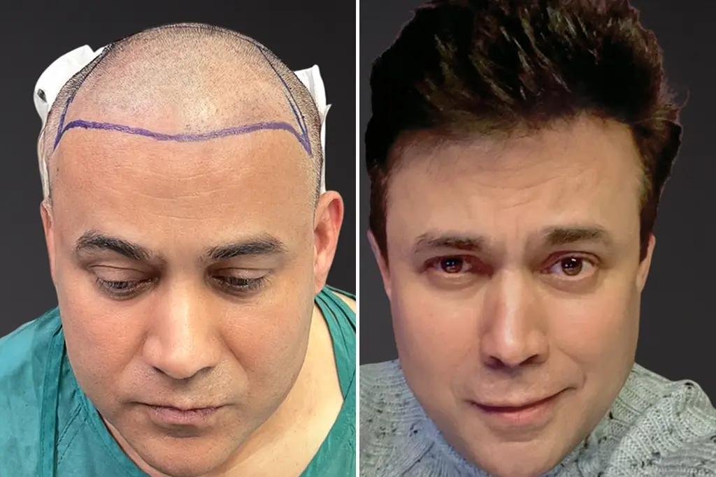Hybrid Hair Transplant