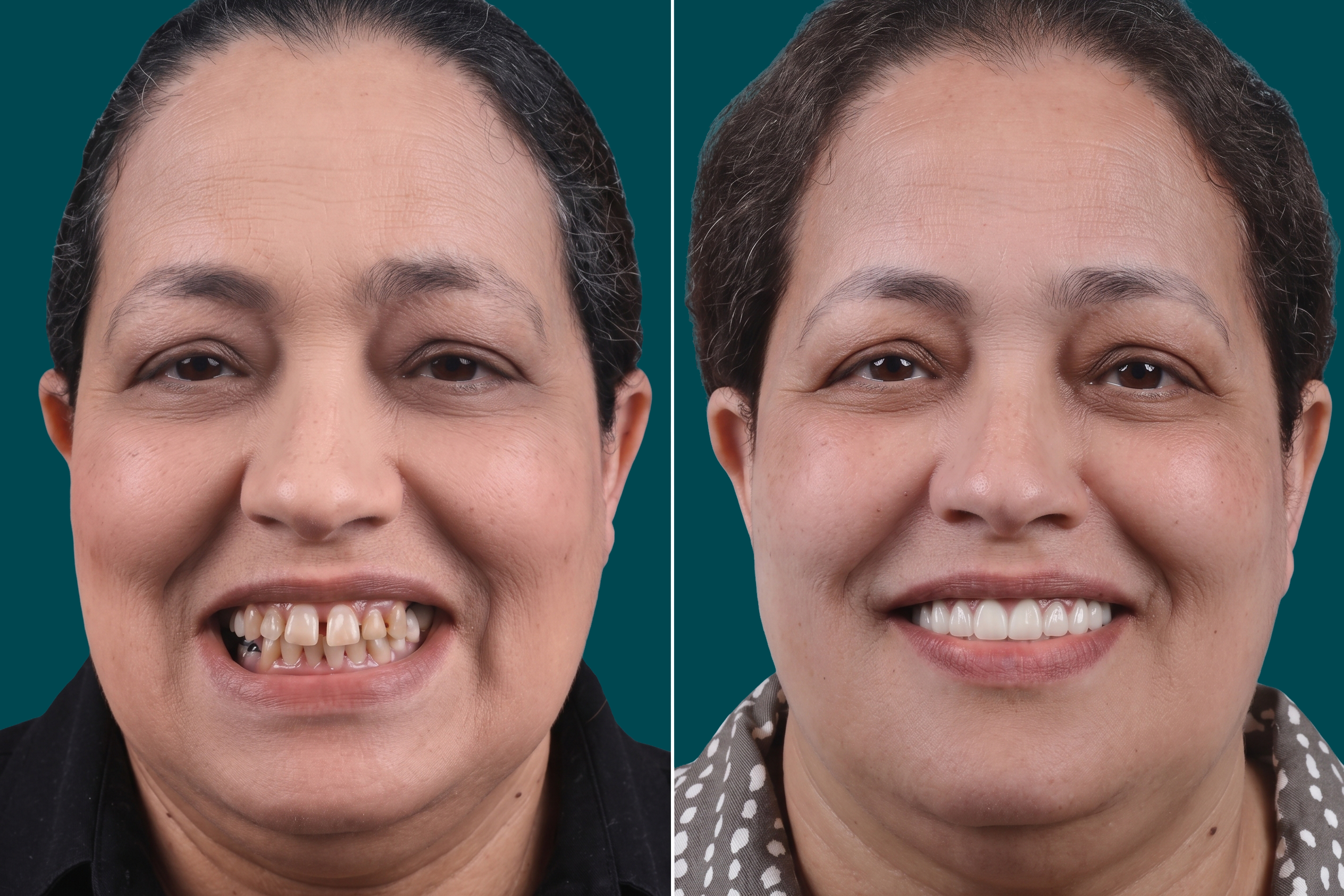 Dental Treatments- Hollywood Smile 