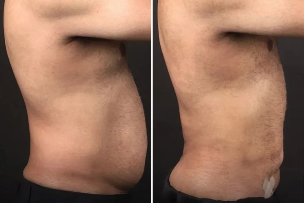 Liposuction1
