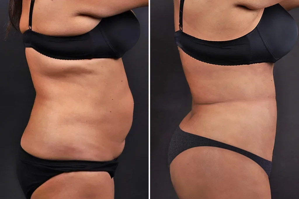 Liposuction2