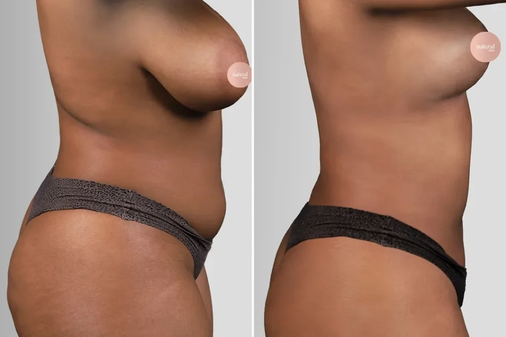 Liposuction4