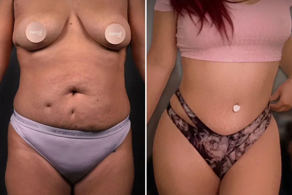 Liposuction5