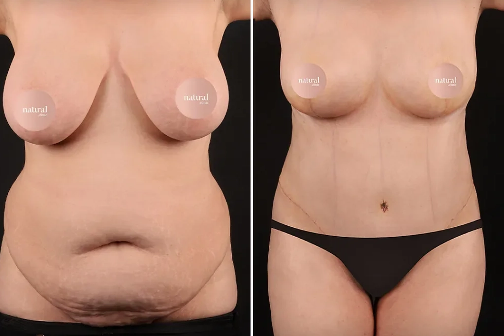 MommyMakeover1