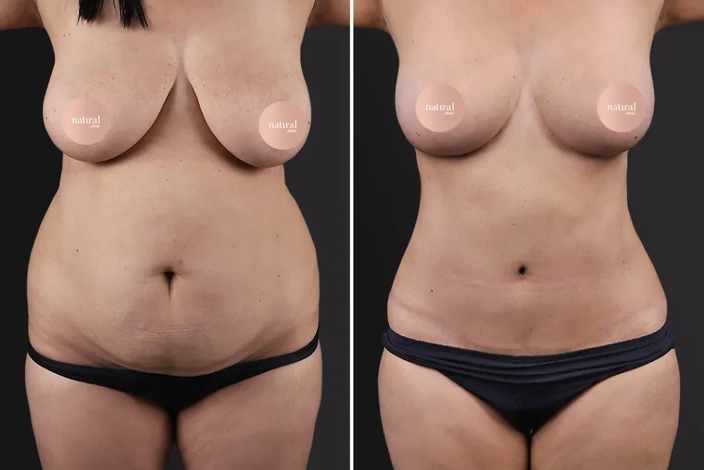 MommyMakeover3